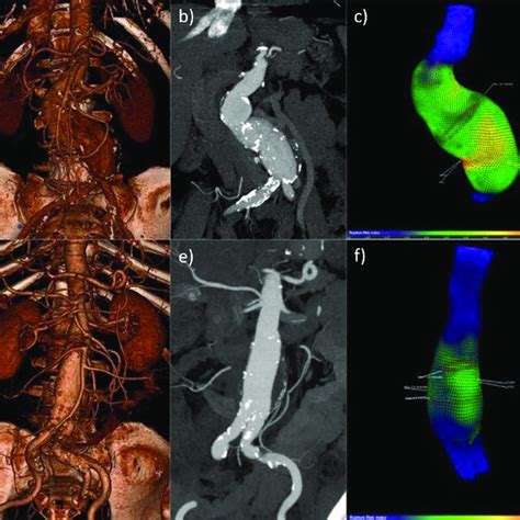 Infrarenal abdominal aortic aneurysm (AAA). Reconstructed CT scan ...