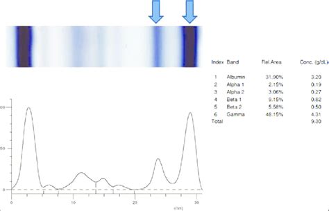 Serum Protein Electrophoresis On Agarose Gel Arrow Depicts Two Bands Download Scientific