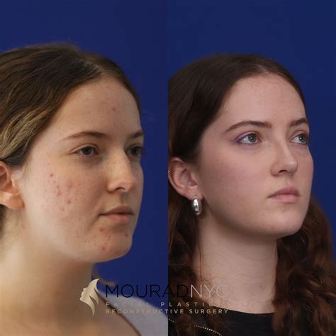 Before And After Female Primary Rhinoplasty Facial Plastic Surgeon