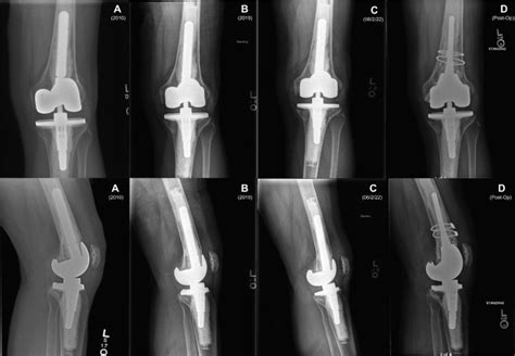 A Rare Case Of Taper Junction Corrosion In Semi Constrained Total Knee