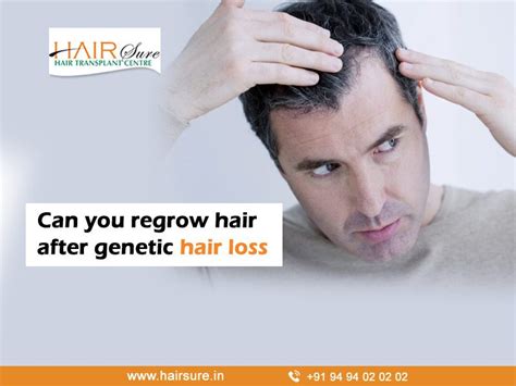 Can you regrow hair after genetic hair loss | Hair Sure