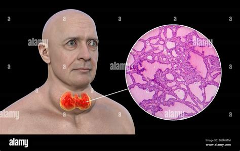 3d Illustration Of A Man With A Toxic Goitre Enlarged Thyroid Gland Base Of Neck And A Close