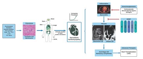 Sarcoidosis