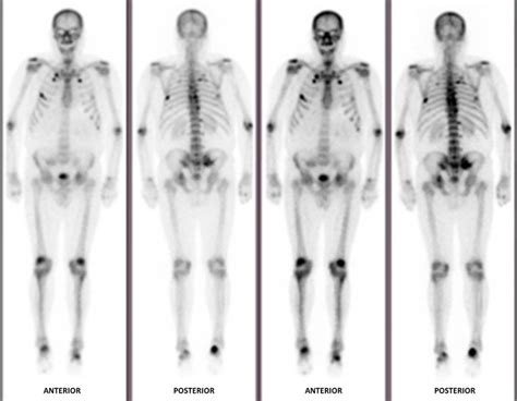 Technetium 99m Hydroxydiphosphonate Whole Body Bone Scintigraphy