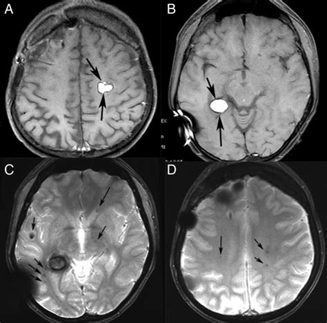 Radiation Induced Intracranial Meningioma And Multiple Cavernomas