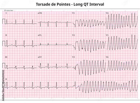 Ecg Torsade De Pointes Long Qt Interval Ventricular Tachycardia