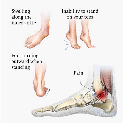 Posterior Tibial Tendonitis Symptoms, Causes Treatments, 57% OFF