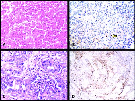 A y B Tumor caso nº1 A Patrón de crecimiento en nidos con