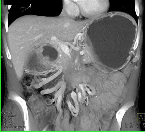 Adenocarcinoma Body Of Pancreas With Vascular Invasion Pancreas Case