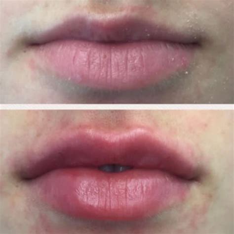 Juvederm for lips. | Face fillers, Juvederm, Dermal fillers