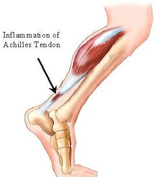 Heel Spur Symptoms - Achilles tendinitis - Health and Fitness