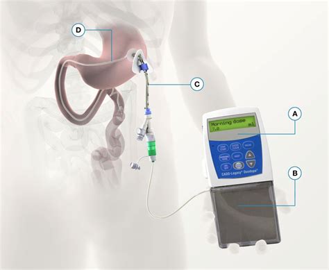 Oral And Infusion Levodopa Therapy In The Management Of Parkinsons