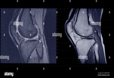 Anatomia rodilla mri Fotos und Bildmaterial in hoher Auflösung Alamy