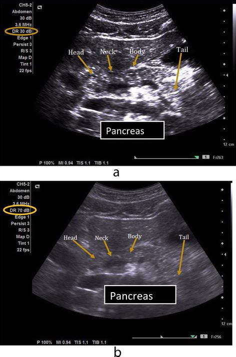 The Influence of Ultrasound Equipment Knobology in Abdominal Sonography | IntechOpen