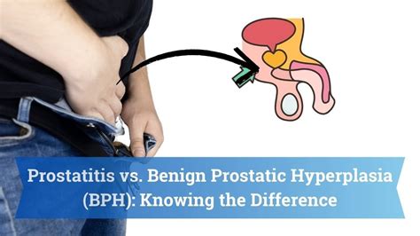 Prostatitis Vs Benign Prostatic Hyperplasia BPH Knowing The Difference