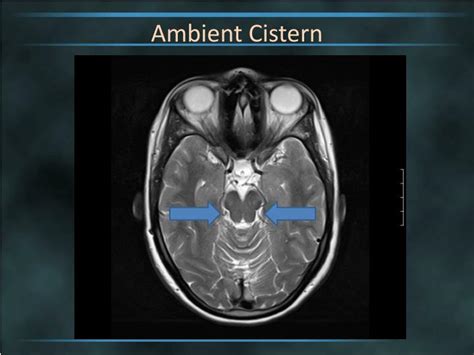 Ppt Brain Cisterns Powerpoint Presentation Id2263744