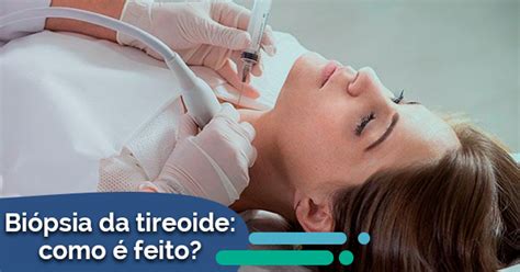 Biópsia da tireoide como é feito Descubra aqui Dr Rafael De Cicco