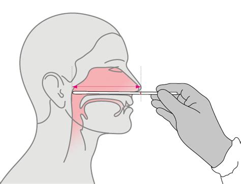 Toma de frotis nasofaríngeo Procedimientos diagnósticos y