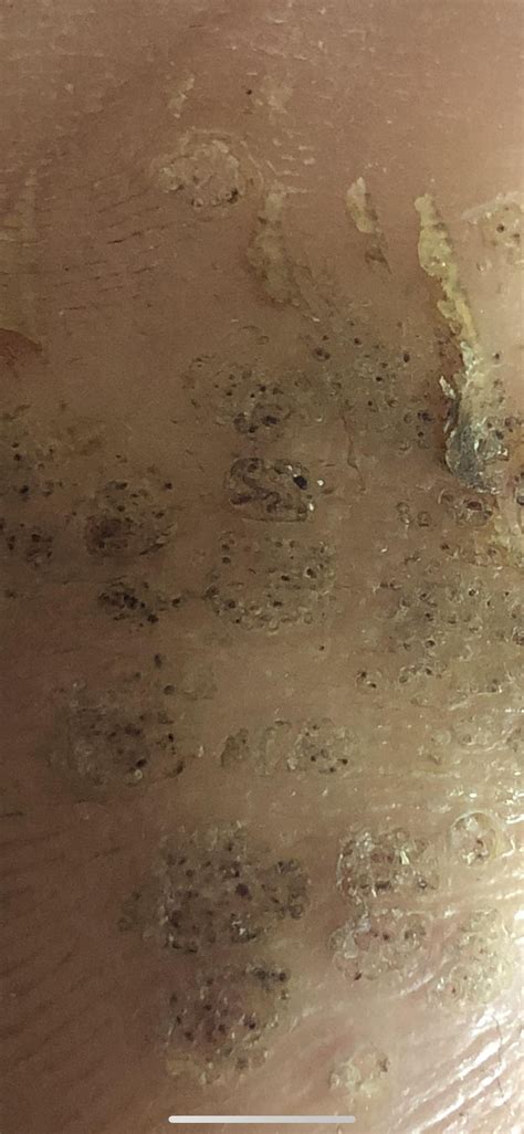 Been treating (100+ tiny warts) mosaic wart for over 2 years. This is ...