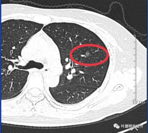 个人观点（202359）：从微浸润性腺癌的诊疗看目前肺结节治疗乱象微浸润性腺癌肺结节腺癌肺癌肺叶肺段消融结节 健康界