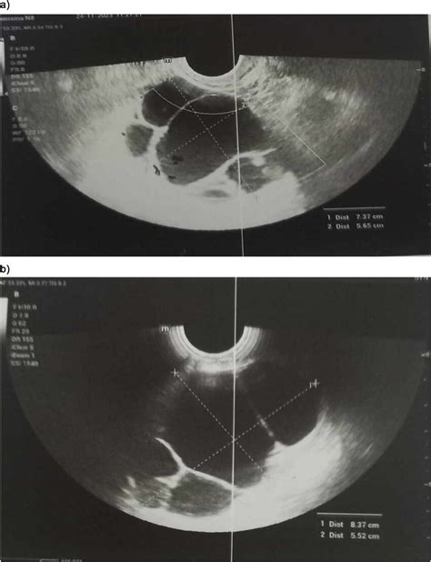 a: Ultrasound Doppler vascularisation. b: Ultrasound measurement. | Download Scientific Diagram