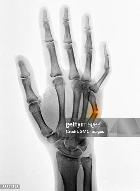 118 Broken Finger X Ray Stock Photos, High-Res Pictures, and Images - Getty Images