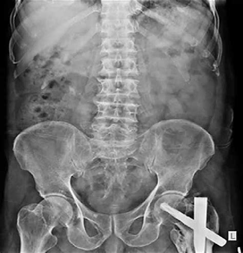 Lateral Lumbar Spine X Ray Labeled