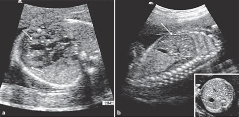 Figure 1 From Prenatal Ultrasound Diagnosis Follow Up And Outcome Of Congenital Varicella