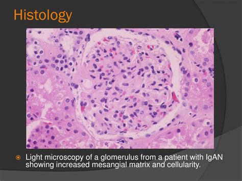 PPT - IgA Nephropathy with crescents PowerPoint Presentation, free ...