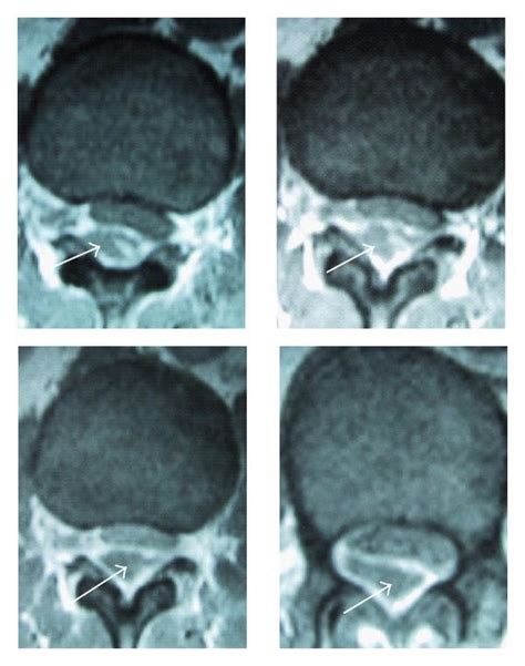 Preoperative T Weighted Mri Scans With Contrast Of Lumbar Spine In A