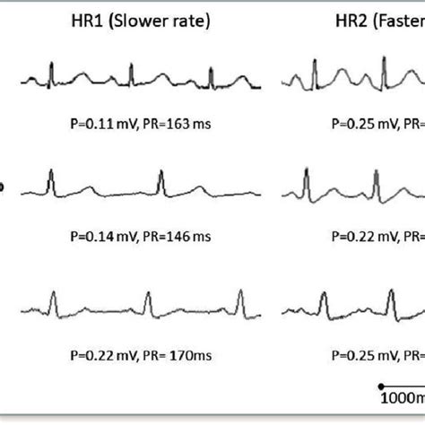 Sample tracings showing changes in P-wave amplitude and PR interval in ...