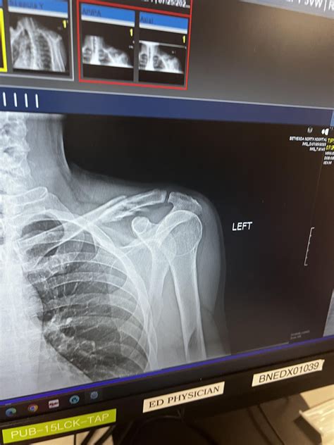 Broken clavicle : r/MedicalGore