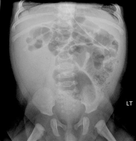 Imaging And Intussusception Adc Education And Practice Edition