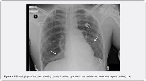 Imaging Findings In Pulmonary Fat Embolism Literature Review And Practical Aspects