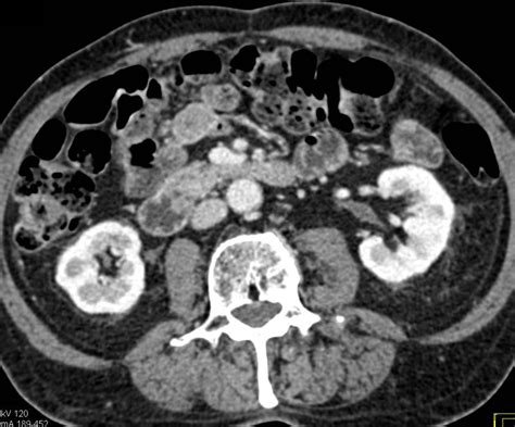 Focal Fatty Infiltration Of The Pancreas Simulates A Mass Pancreas