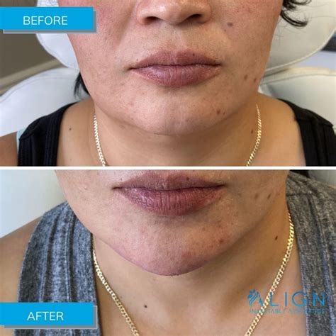 Before And After Chin Filler At Align Align Injectable Aesthetics