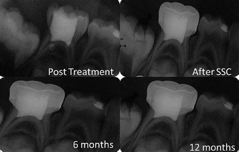 Follow Up Radiographs After Diode Laser And Zinc Oxide Eugenol