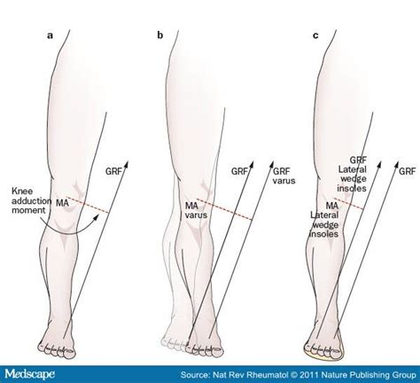 What Does Knee Adduction Moment Mean In Yoga Exercise Knee Arthritis