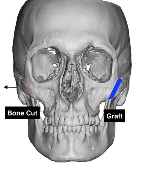 Zygomatic Widening Osteotomy Diagram Dr Barry Eppley Copyedited 1