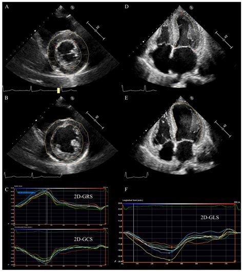 Echocardiogram Heart Failure