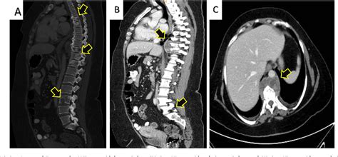 Figure 1 From Primary Extraskeletal Ewing Sarcoma Of The Foot With