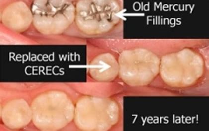 Cerec crown review - bopqelets