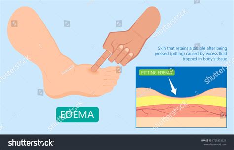 Edema Swelling Under The Skin That Affect With Royalty Free Stock