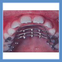 Orthodontics Brackets at Best Price in Ghaziabad - ID: 3626151 ...