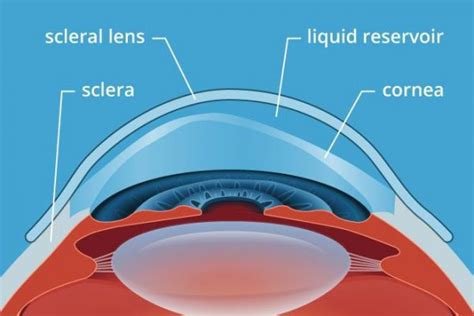 Keratoconus Diagram