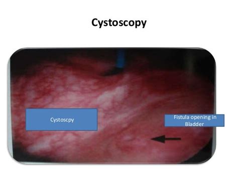 Obstetric fistula