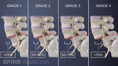 L5-S1 Isthmic Spondylolisthesis Animation | Spine-health