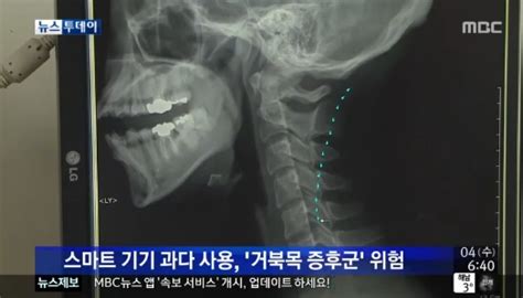 거북목 증후군이란 스마트폰·pc 장시간 사용 위험