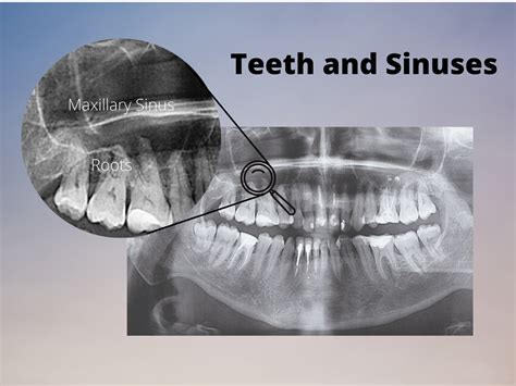 Sinus Infections And Tooth Pain — Dr Scott Solomons