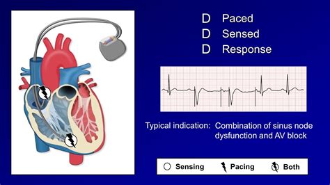 Pacemaker Modes And Settings Youtube